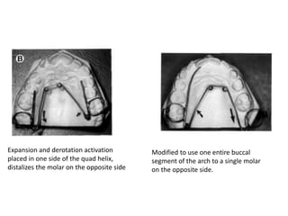 Expansion and derotation activation
placed in one side of the quad helix,
distalizes the molar on the opposite side
Modified to use one entire buccal
segment of the arch to a single molar
on the opposite side.
 