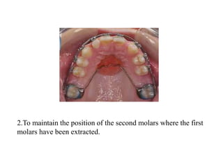 2.To maintain the position of the second molars where the first
molars have been extracted.
 