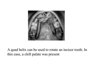 A quad helix can be used to rotate an incisor tooth. In
this case, a cleft palate was present
 