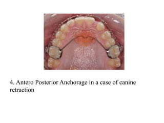 4. Antero Posterior Anchorage in a case of canine
retraction
 