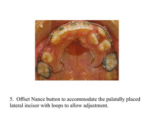 5. Offset Nance button to accommodate the palatally placed
lateral incisor with loops to allow adjustment.
 