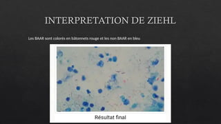 INTERPRETATION DE ZIEHL
Les BAAR sont colorés en bâtonnets rouge et les non BAAR en bleu
 