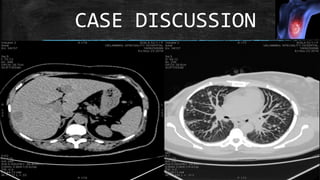 CASE DISCUSSION
 
