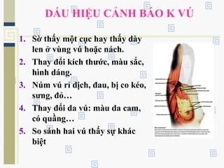 DẤU HIỆU CẢNH BÁO K VÚ
1. Sờ thấy một cục hay thấy dày
len ở vùng vú hoặc nách.
2. Thay đổi kích thước, màu sắc,
hình dáng.
3. Núm vú rỉ dịch, đau, bị co kéo,
sưng, đỏ…
4. Thay đổi da vú: màu da cam,
có quầng…
5. So sánh hai vú thấy sự khác
biệt
 