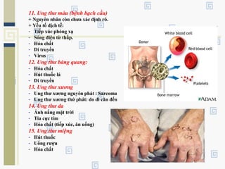 11. Ung thư máu (bệnh bạch cầu)
+ Nguyên nhân còn chưa xác định rõ.
+ Yếu tố dịch tễ:
- Tiếp xúc phóng xạ
- Sóng điện từ thấp.
- Hóa chất
- Di truyền
- Virus
12. Ung thư bàng quang:
- Hóa chất
- Hút thuốc lá
- Di truyền
13. Ung thư xương
- Ung thư xương nguyên phát : Sarcoma
- Ung thư xương thứ phát: do di căn đến
14. Ung thư da
- Ánh nắng mặt trời
- Tia cực tím
- Hóa chất (tiếp xúc, ăn uống)
15. Ung thư miệng
- Hút thuốc
- Uống rượu
- Hóa chất
 
