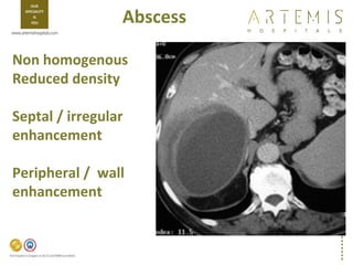 Absccess Triphasic Ct Scan TPCT - Triphasic CT Scan - Liver | PPT