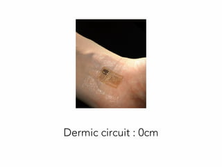 Dermic circuit : 0cm
 