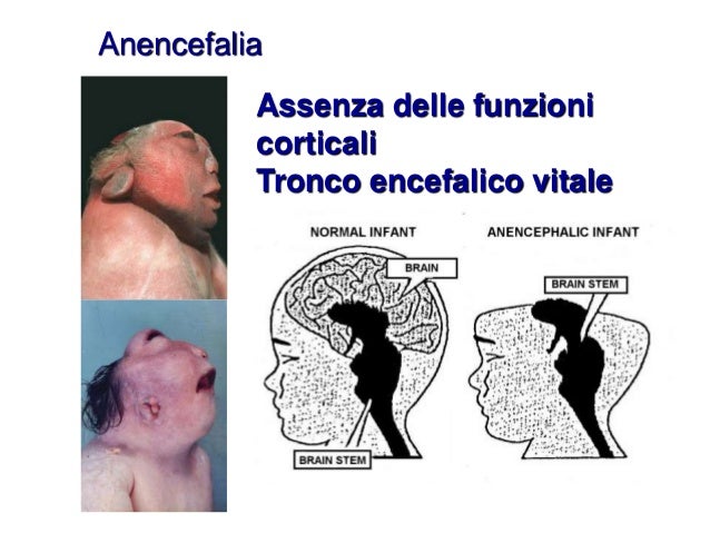 Diagnosi Di Morte Con Criteri Neurologici