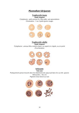 Plasmodium falciparum
                                Trophozoïte jeune
                                   Stade fréquent
              Cytoplasme : petit anneau fin, bleu pâle, sans granulations
                      Chromatine : 1 ou 2 petits grains rouges




                                Trophozoïte adulte
                                  Stade fréquent
      Cytoplasme : anneau bleu soutenu épais, ou aspect en virgule, ou en point
                                  d'exclamation




                                     Schizonte
                                      Très rare
Pratiquement jamais trouvés dans les étalements de sang (sauf dans les cas très graves)
                               Mérozoites : 18 à 32
                            Pigment: brun foncé ou noir




                                          18
 