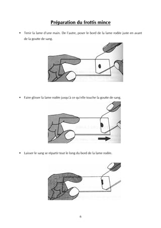 Préparation du frottis mince

Tenir la lame d'une main. De l'autre, poser le bord de la lame rodée juste en avant
de la goutte de sang.




Faire glisser la lame rodée jusqu'à ce qu'elle touche la goutte de sang.




Laisser le sang se répartir tout le long du bord de la lame rodée.




                                         6
 