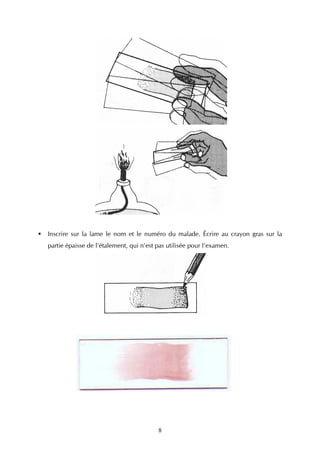 Inscrire sur la lame le nom et le numéro du malade. Écrire au crayon gras sur la
partie épaisse de l'étalement, qui n'est pas utilisée pour l'examen.




                                         8
 
