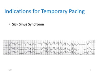 Temporary pacemaker toufiqur rahman | PPSX
