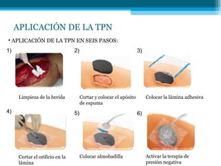 APLICACIÓN DE LA TPN
Limpieza de la herida Cortar y colocar el apósito
de espuma
Colocar la lámina adhesiva
Cortar el orificio en la
lámina
Colocar almohadilla Activar la terapia de
presión negativa
1) 2) 3)
4) 5) 6)
• APLICACIÓN DE LA TPN EN SEIS PASOS:
 