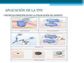 APLICACIÓN DE LA TPN
• TÉCNICAS ESPECÍFICAS DE LA COLOCACIÓN DE APÓSITO
 