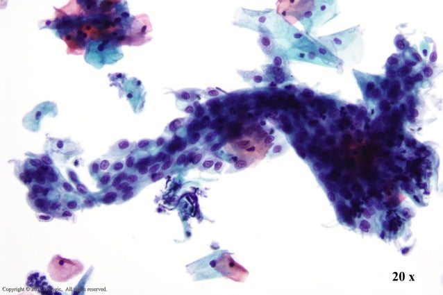Thin prep morphology (Cervical cytology) | PPT