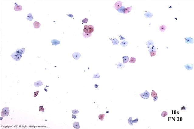 Thin prep morphology (Cervical cytology) | PPT