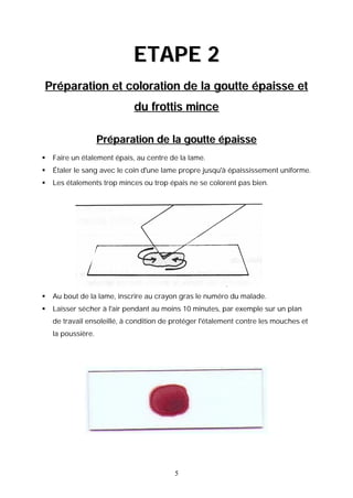 ETAPE 2
Préparation et coloration de la goutte épaisse et
                             du frottis mince

                    Préparation de la goutte épaisse
   Faire un étalement épais, au centre de la lame.
   Étaler le sang avec le coin d'une lame propre jusqu'à épaississement uniforme.
   Les étalements trop minces ou trop épais ne se colorent pas bien.




   Au bout de la lame, inscrire au crayon gras le numéro du malade.
   Laisser sécher à l'air pendant au moins 10 minutes, par exemple sur un plan
    de travail ensoleillé, à condition de protéger l'étalement contre les mouches et
    la poussière.




                                          5
 