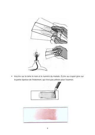    Inscrire sur la lame le nom et le numéro du malade. Écrire au crayon gras sur
    la partie épaisse de l'étalement, qui n'est pas utilisée pour l'examen.




                                           8
 