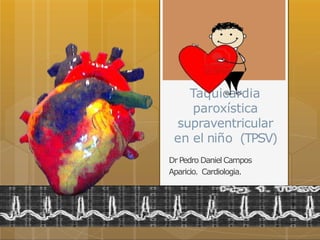 Taquicardia
paroxística
supraventricular
en el niño (TPSV)
Dr Pedro Daniel Campos
Aparicio. Cardiologia.
 