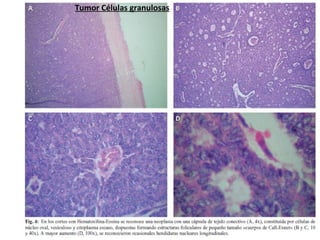 Tp tumores ovaricos y endometriosis 2015