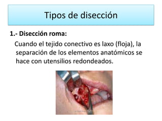 Tipos de disección
1.- Disección roma:
  Cuando el tejido conectivo es laxo (floja), la
  separación de los elementos anatómicos se
  hace con utensilios redondeados.
 