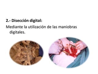 2.- Disección digital:
Mediante la utilización de las maniobras
  digitales.
 
