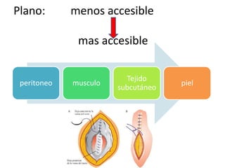 Plano:       menos accesible

              mas accesible

                         Tejido
 peritoneo   musculo                piel
                       subcutáneo
 