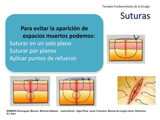Tiempos Fundamentales de la Cirugía


                                                                                                      Suturas
       Para evitar la aparición de
        espacios muertos podemos:
  Suturar en un solo plano
  Suturar por planos
  Aplicar puntos de refuerzo




ROMERO Domínguez, Manuel., Martínez Galeana , José Antonio., Vega Pérez, Javier Francisco. Manual de cirugía menor, Ediciones
S.L Aran.
 