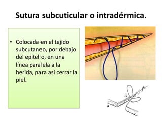 Sutura subcuticular o intradérmica.

• Colocada en el tejido
  subcutaneo, por debajo
  del epitelio, en una
  línea paralela a la
  herida, para así cerrar la
  piel.
 