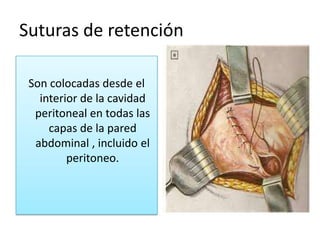 Suturas de retención

 Son colocadas desde el
   interior de la cavidad
  peritoneal en todas las
     capas de la pared
  abdominal , incluido el
         peritoneo.
 