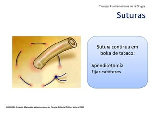 Tiempos Fundamentales de la Cirugía


                                                                                                         Suturas


                                                                                           Sutura continua em
                                                                                            bolsa de tabaco:

                                                                                         Apendicetomía
                                                                                         Fijar catéteres




LUGO Olin Ernesto, Manual de adiestramiento en Cirugía, Editorial Trillas, México 2000
 
