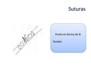 Suturas



 Punto en forma de 8:

Tendón
 