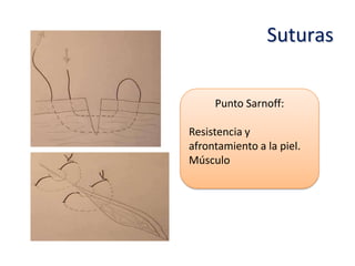 Suturas


     Punto Sarnoff:

Resistencia y
afrontamiento a la piel.
Músculo
 