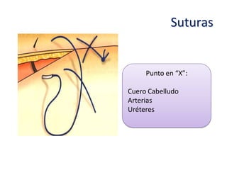 Suturas


     Punto en “X”:

Cuero Cabelludo
Arterias
Uréteres
 