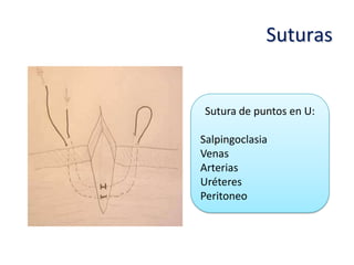Suturas


Sutura de puntos en U:

Salpingoclasia
Venas
Arterias
Uréteres
Peritoneo
 