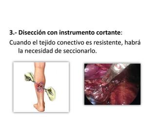 3.- Disección con instrumento cortante:
Cuando el tejido conectivo es resistente, habrá
la necesidad de seccionarlo.
 