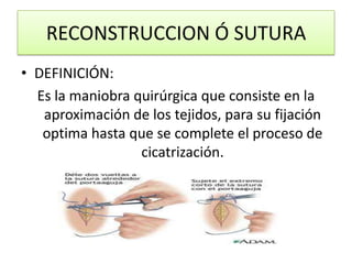 RECONSTRUCCION Ó SUTURA
• DEFINICIÓN:
Es la maniobra quirúrgica que consiste en la
aproximación de los tejidos, para su fijación
optima hasta que se complete el proceso de
cicatrización.
 