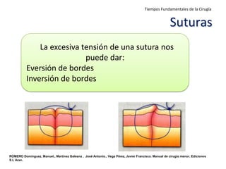 ROMERO Domínguez, Manuel., Martínez Galeana , José Antonio., Vega Pérez, Javier Francisco. Manual de cirugía menor, Ediciones
S.L Aran.
La excesiva tensión de una sutura nos
puede dar:
Eversión de bordes
Inversión de bordes
Suturas
Tiempos Fundamentales de la Cirugía
 