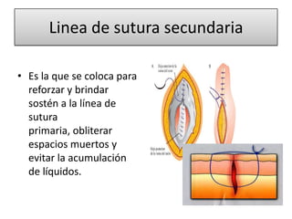 Linea de sutura secundaria
• Es la que se coloca para
reforzar y brindar
sostén a la línea de
sutura
primaria, obliterar
espacios muertos y
evitar la acumulación
de líquidos.
 