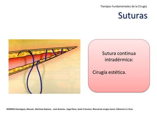 ROMERO Domínguez, Manuel., Martínez Galeana , José Antonio., Vega Pérez, Javier Francisco. Manual de cirugía menor, Ediciones S.L Aran.
Sutura continua
intradérmica:
Cirugía estética.
Suturas
Tiempos Fundamentales de la Cirugía
 