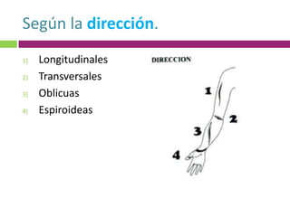 Según la dirección.
1)   Longitudinales
2)   Transversales
3)   Oblicuas
4)   Espiroideas
 