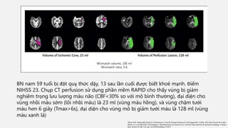 BN nam 59 tuổi bị đột quỵ thức dậy, 13 sau lần cuối được biết khoẻ mạnh. Điểm
NIHSS 23. Chụp CT perfusion sử dụng phần mềm RAPID cho thấy vùng bị giảm
nghiêm trọng lưu lượng máu não (CBF<30% so với mô bình thường), đại diện cho
vùng nhồi máu sớm (lõi nhồi máu) là 23 ml (vùng màu hồng), và vùng chậm tưới
máu hơn 6 giây (Tmax>6s), đại diện cho vùng mô bị giảm tưới máu là 128 ml (vùng
màu xanh lá)
Albers GW, Marks MP, Kemp S, Christensen S, Tsai JP, Ortega-Gutierrez S, McTaggart RA, Torbey MT, Kim-Tenser M, Leslie-
Mazwi T, et al; DEFUSE 3 Investigators. Thrombectomy for stroke at 6 to 16 hours with selection by perfusion imaging. N Engl J
Med. 2018;378:708–718. doi: 10.1056/NEJMoa1713973
 