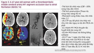 Horst Urbach, Elias Kellner and Karl Egger. Acute stroke imaging in the Era of the DAWN,
DEFUSE 3 and WAKE-UP study findings (2019) European Neurological Review 14(1): 24-27
-Thể tích lõi nhồi máu (CBF <30%
vùng màu đỏ): 43ml
-Thể tích pnenumbra (Tmax>6s
vùng màu vàng) 92 ml
-Mismatch vùng thiếu máu /lõi nhồi
máu: 3,1
-(A) CTP sau 60 phút cho thấy mô
nhu mô não nguy cơ do đm MCA chi
phối
-(C) nhánh M1 MCA thuyên tắc
huyết khối do rung nhĩ
-(G) đm MCA được tái thông bằng
solitaire
-(H) CT sau 1 ngày cho thấy vùng
nhồi máu mới của MCA ở vỏ não
(mũi tên lớn) trong khi vùng giảm
đậm độ ở nhân đậu bên phải đã thấy
trên CT ban đầu (B, D, H: mũi tên
nhỏ)
 