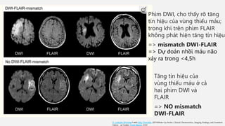 Phim DWI, cho thấy rõ tăng
tín hiệu của vùng thiếu máu;
trong khi trên phim FLAIR
không phát hiện tăng tín hiệu
=> mismatch DWI-FLAIR
=> Dự đoán nhồi máu não
xảy ra trong <4,5h
Tăng tín hiệu của
vùng thiếu máu ở cả
hai phim DWI và
FLAIR
=> NO mismatch
DWI-FLAIR
D. Leander Rimmele1 and Götz Thomalla. (2014)Wake-Up Stroke: Clinical Characteristics, Imaging Findings, and Treatment
Option – an Update. Front Neurol, (5)35
 