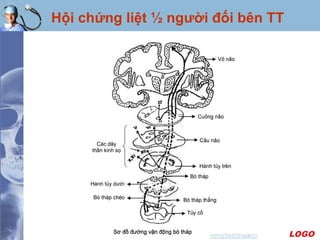LOGO
Hội chứng liệt ½ người đối bên TT
 