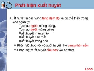 LOGO
Phát hiện xuất huyết
Xuất huyết là các vùng tăng đậm độ và có thể thấy trong
các bệnh lý:
Tụ máu ngoài màng cứng,
Tụ máu dưới màng cứng
Xuất huyết màng não
Xuất huyết não thất
Xuất huyết trong não
 Phân biệt hoá vôi và xuất huyết nhỏ vùng nhân nền
 Phân biệt xuất huyết cầu não với artéfact
 