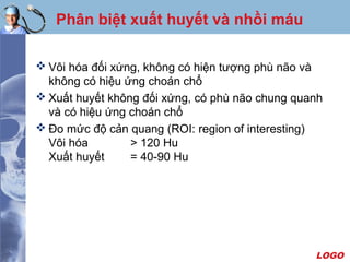 LOGO
Phân biệt xuất huyết và nhồi máu
 Vôi hóa đối xứng, không có hiện tượng phù não và
không có hiệu ứng choán chổ
 Xuất huyết không đối xứng, có phù não chung quanh
và có hiệu ứng choán chổ
 Ðo mức độ cản quang (ROI: region of interesting)
Vôi hóa > 120 Hu
Xuất huyết = 40-90 Hu
 