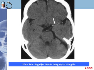 LOGO
Hình ảnh tăng đậm độ của động mạch não giữa
 