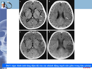 LOGO
Dot’s sign: hình ảnh tăng đậm độ của các nhánh động mạch não giữa trong khe sylvius
 