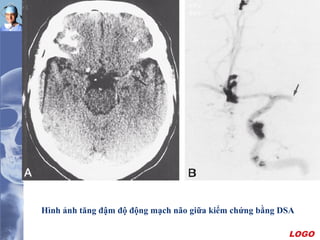 LOGO
Hình ảnh tăng đậm độ động mạch não giữa kiểm chứng bằng DSA
 